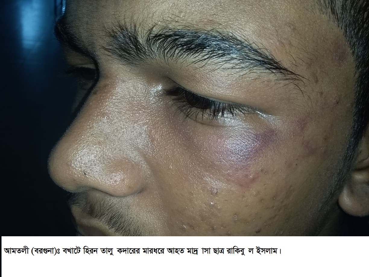 আমতলীতে সপ্তম শ্রেনীর ছাত্রকে বেধরক মারধর!