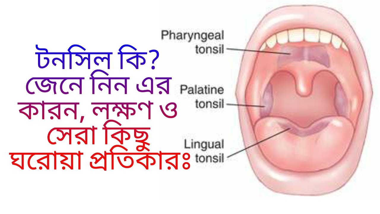 টনসিল সমস্যা ও করণীয়