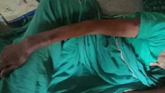 শাশুড়ী কে ঘরের ভিতর ঢুকে মারপিট ও হাতে কামড় দিয়ে রক্তাক্ত